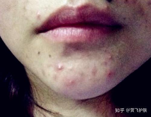 毛孔大导致长痘怎样护理 知乎