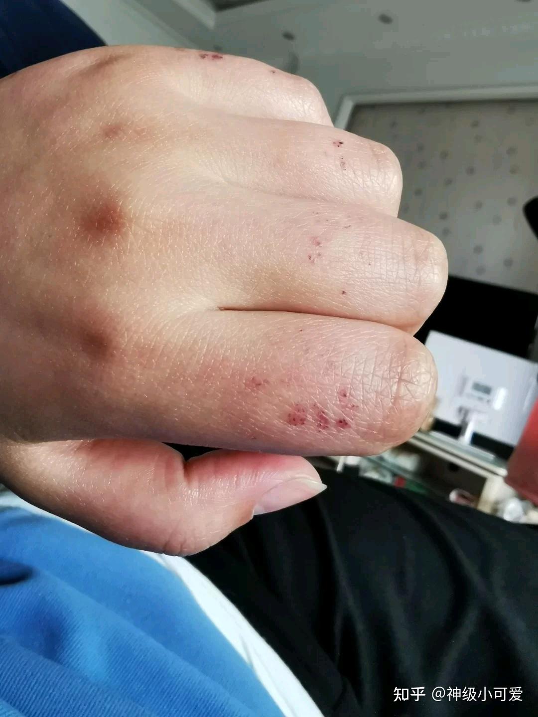 摸着有小硬块,还带一点肿胀的感觉,打电话问了我妈才知道是长了冻疮