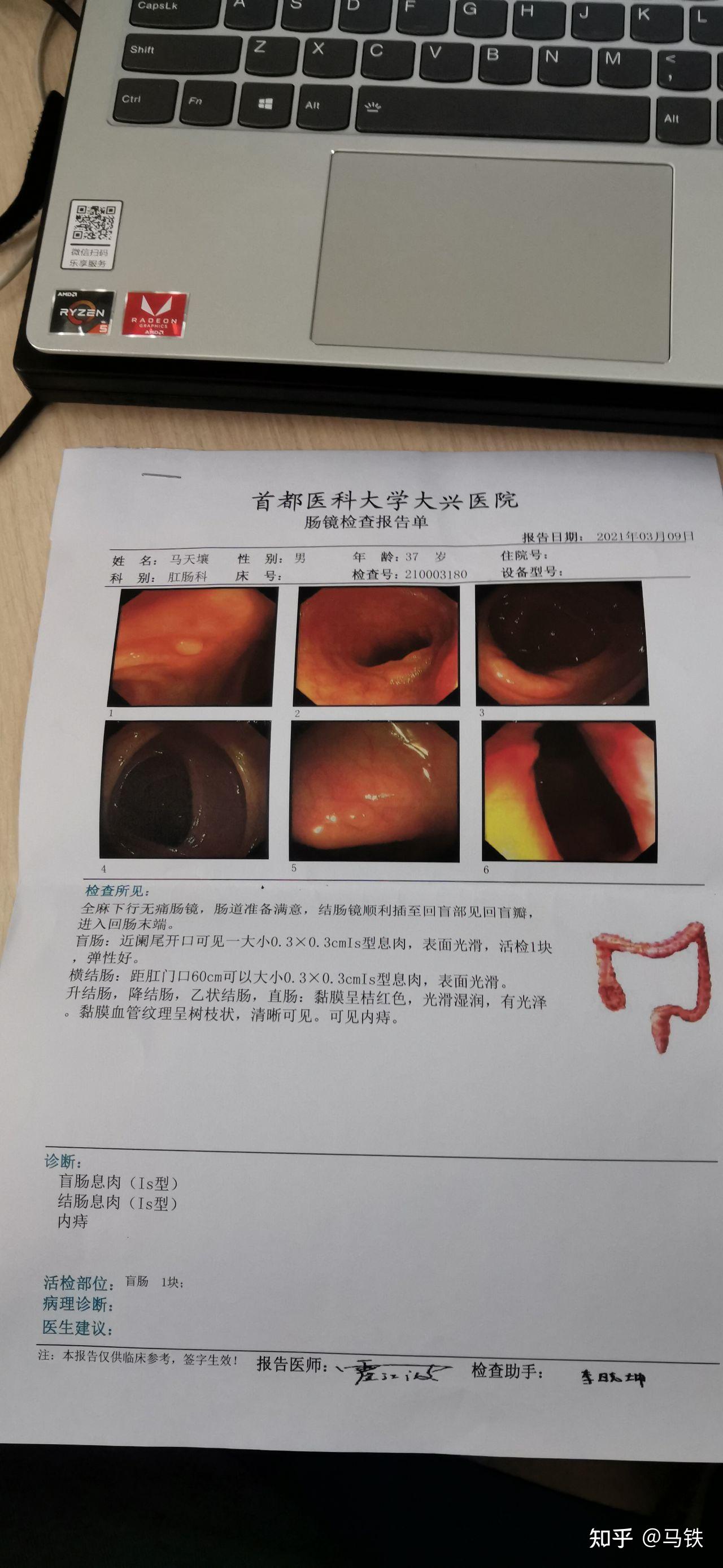 肠镜要做多久图片