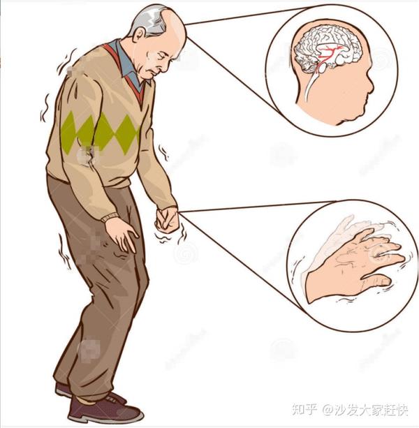 些非运动症状,包括便秘,嗅觉障碍,睡眠障碍,自主神经功能障碍及旧神