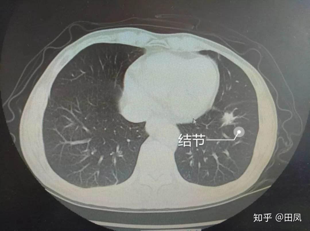 肺的结构-外科学-医学