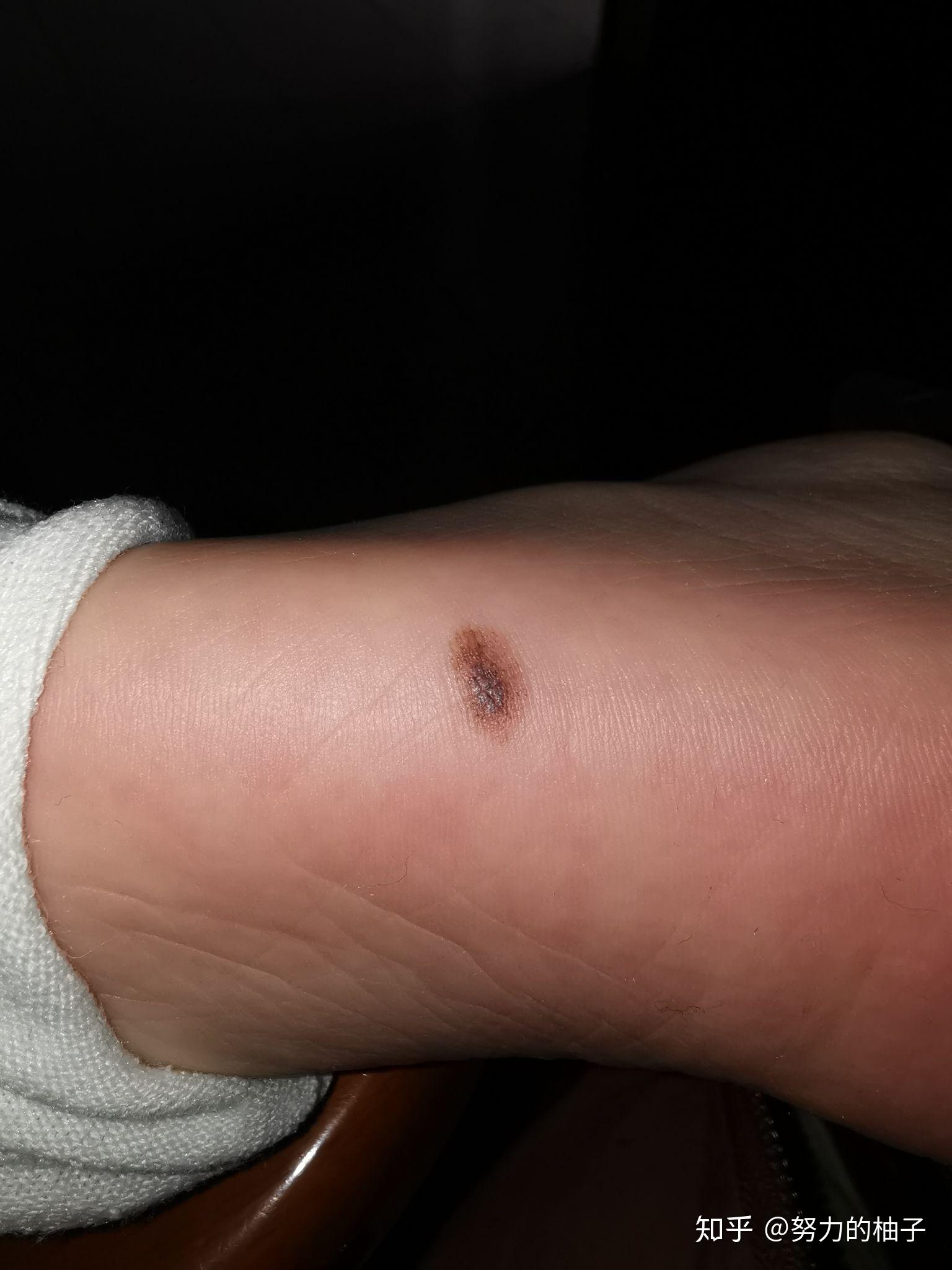 脚底板长了一颗痣