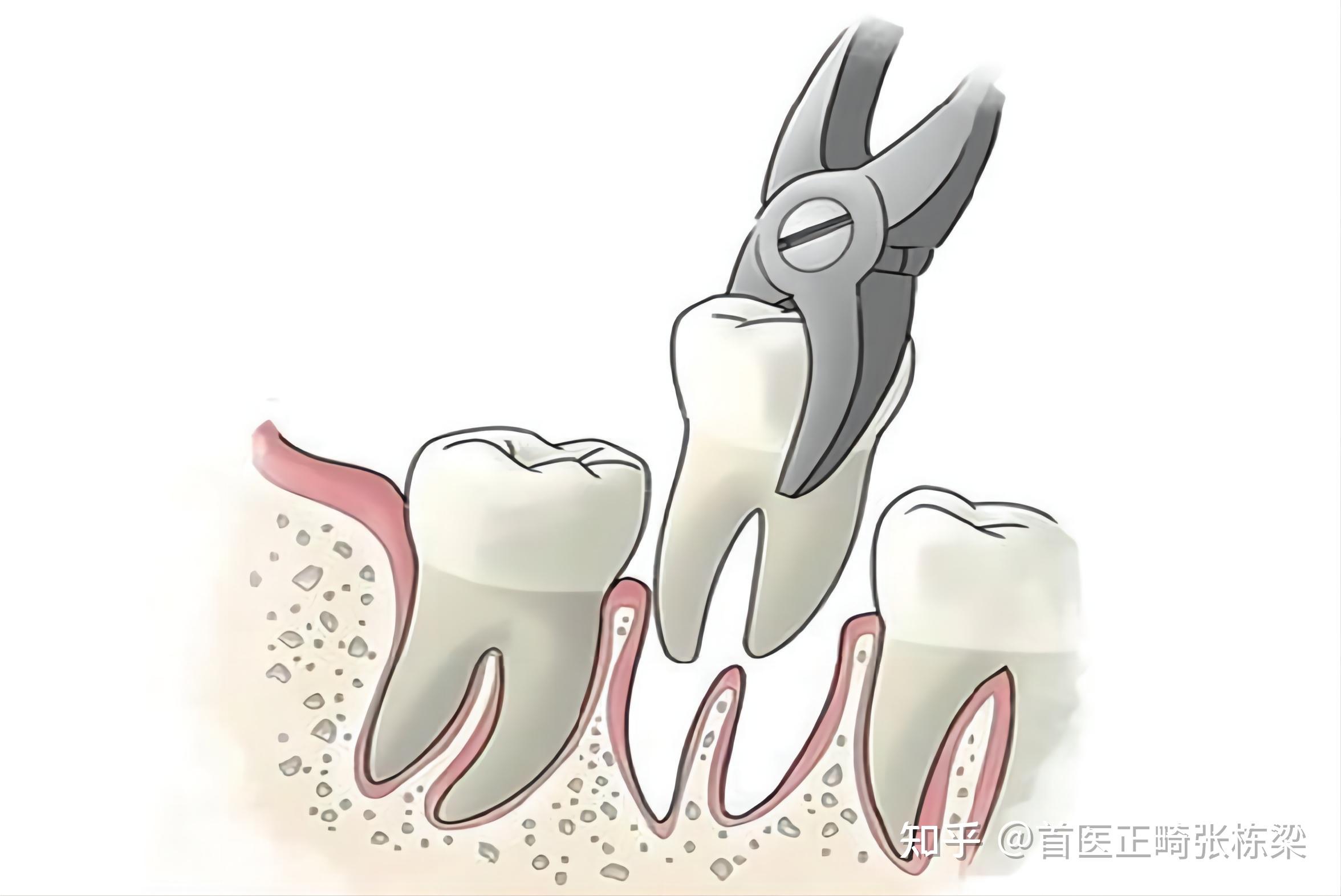 正畸拔牙可能会有什么危害包括老了以后