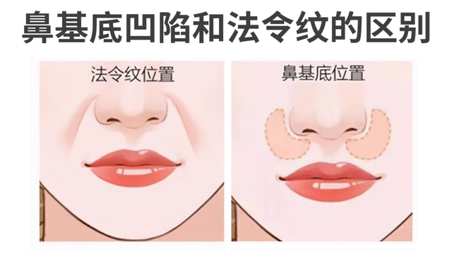 鼻基底和法令纹有什么区别?你真的分得清吗? - 知乎