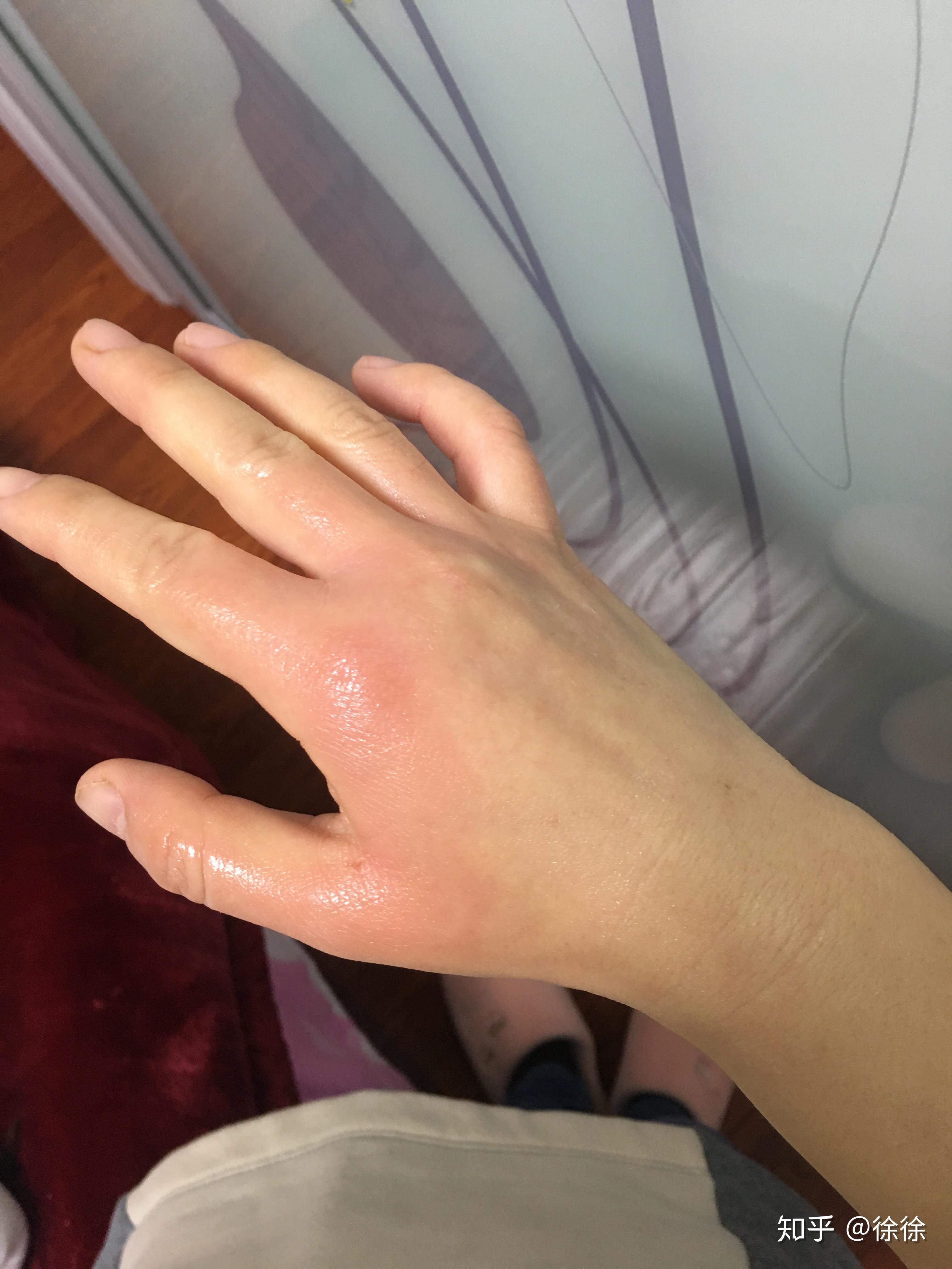 烫伤起的水泡可以戳破吗? - 知乎