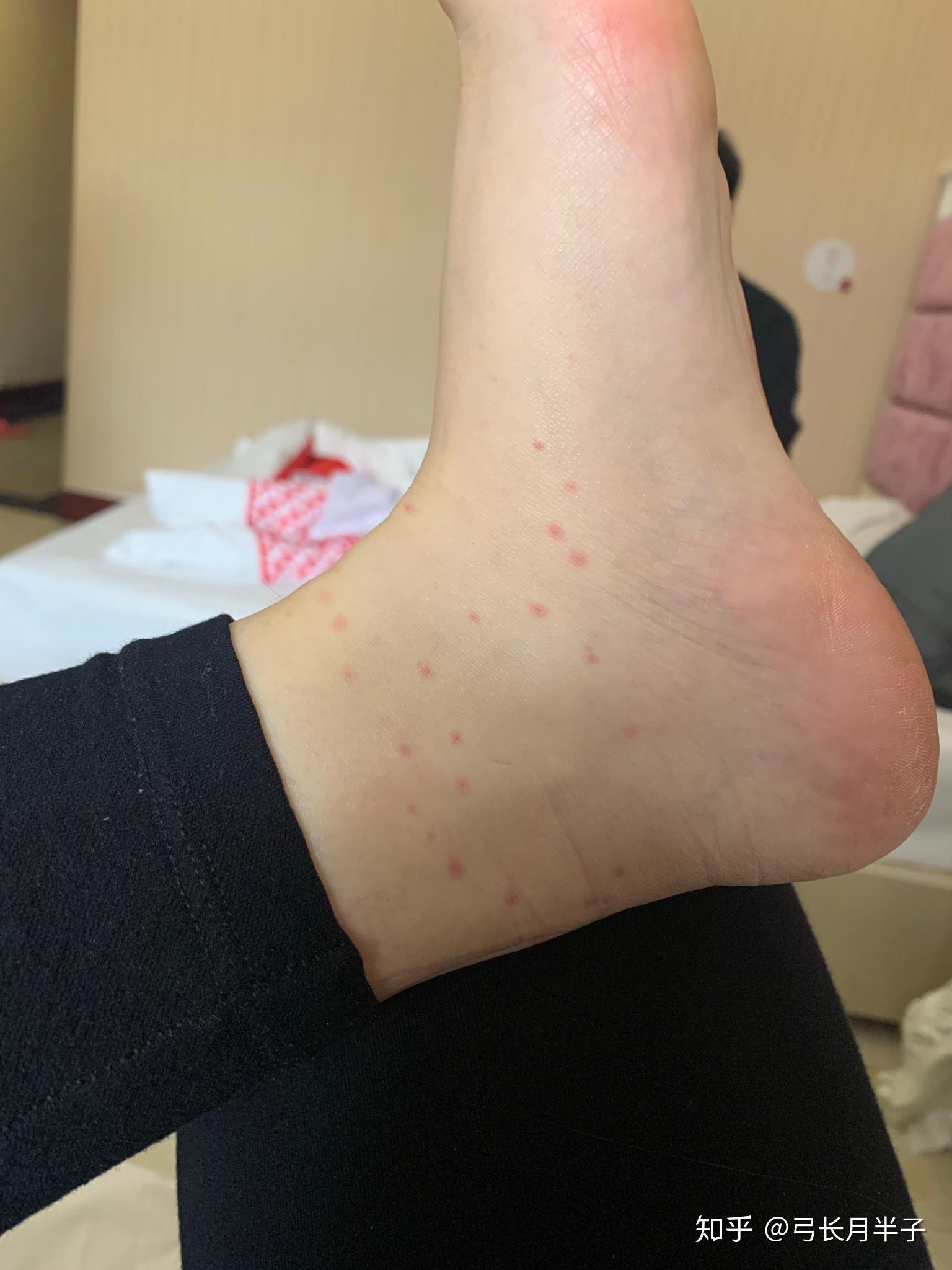 为什么我被蚊子咬了不起包只有一个小红点是什么原因