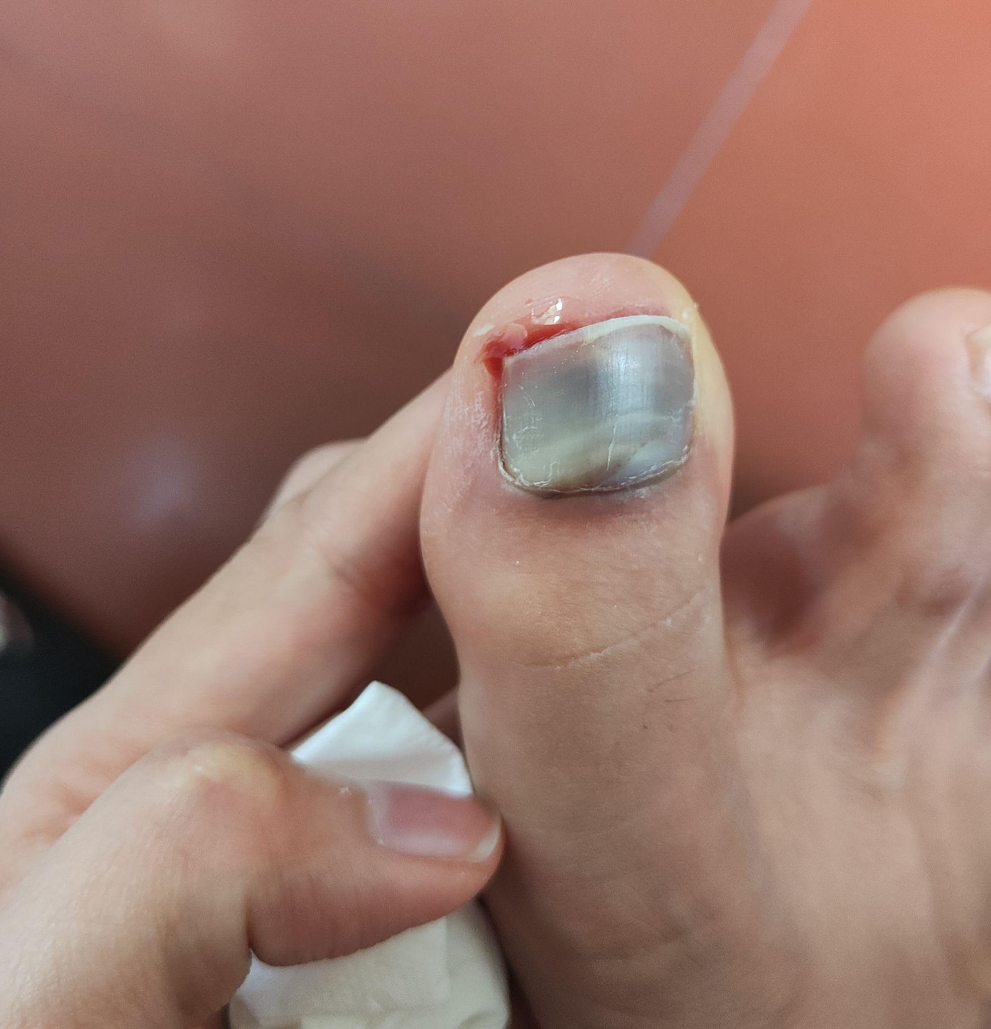 打篮球脚趾甲里面有淤血? - 知乎