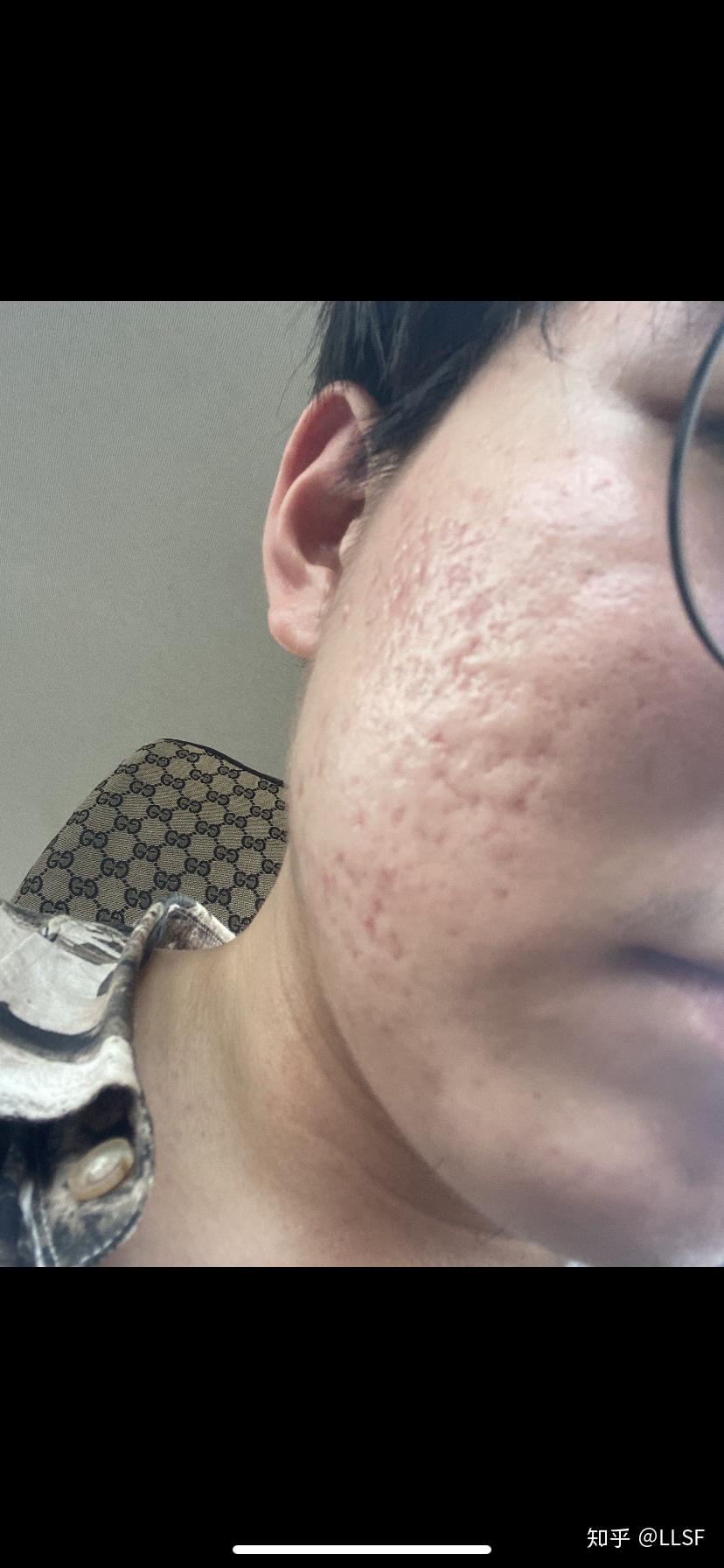 问下各位坑友我这个痘坑程度是不是属于比较严重啊做啥激光比较合适啊