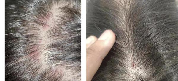 男生脱发严重，发缝宽，发际线下移，差点秃头，看起来成熟了不止十岁！有没有什么科学有效的防脱办法？ - 知乎
