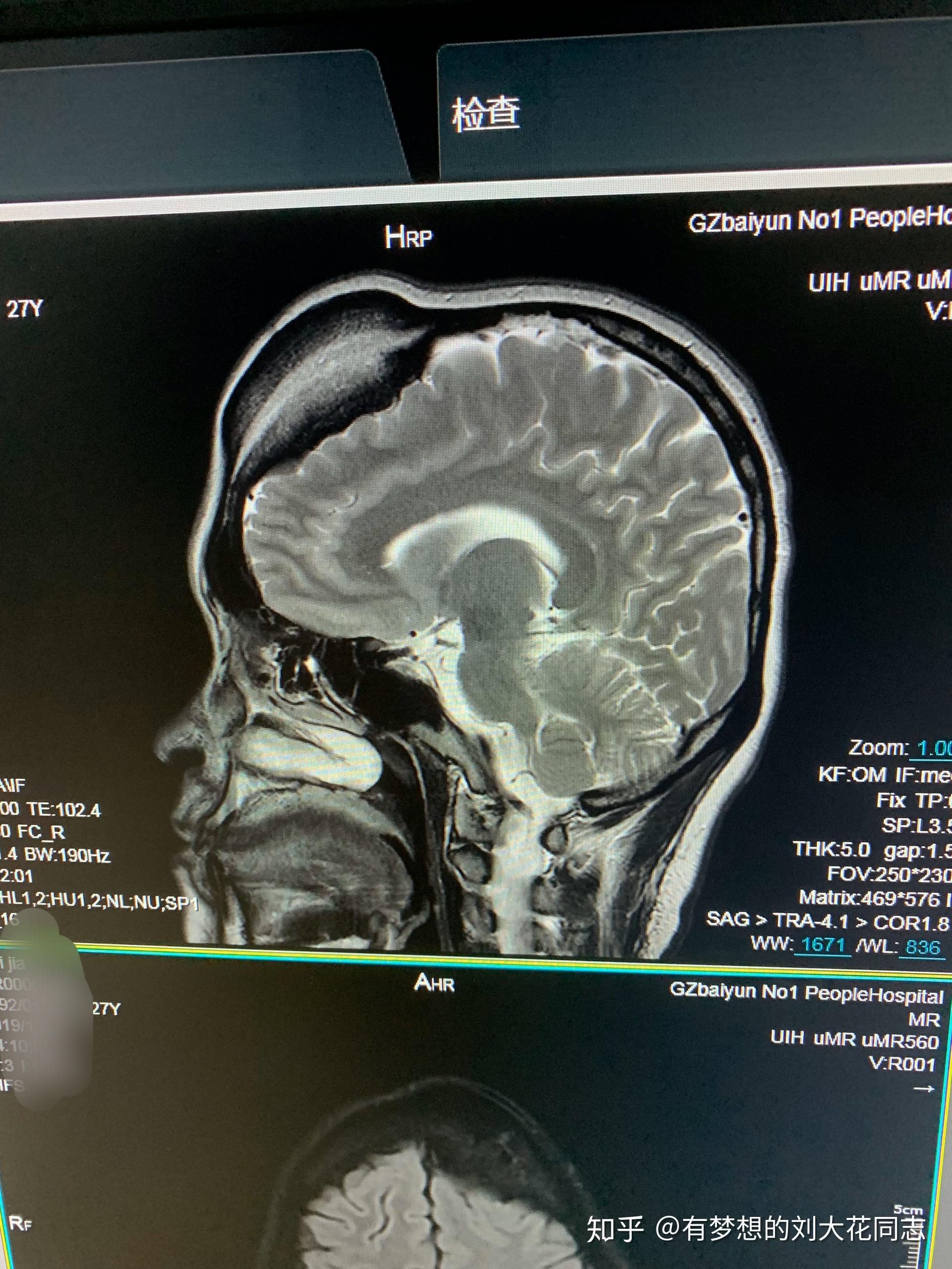 我頭上長了一個顱骨骨瘤專家說沒有關係可是我發現它在緩慢的長大明天