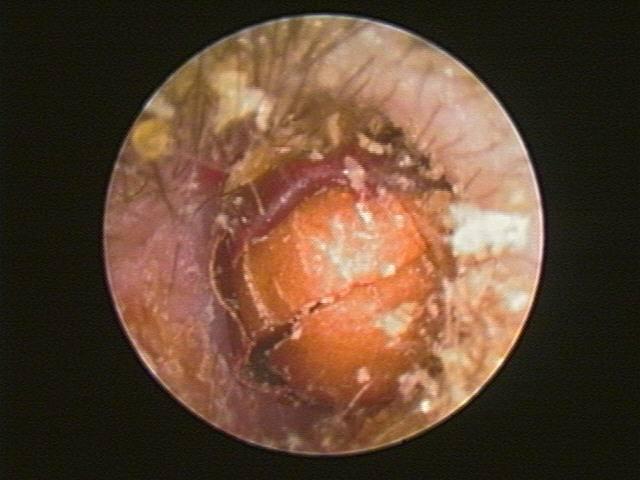 虫子爬进耳朵里会发生什么可怕的事情