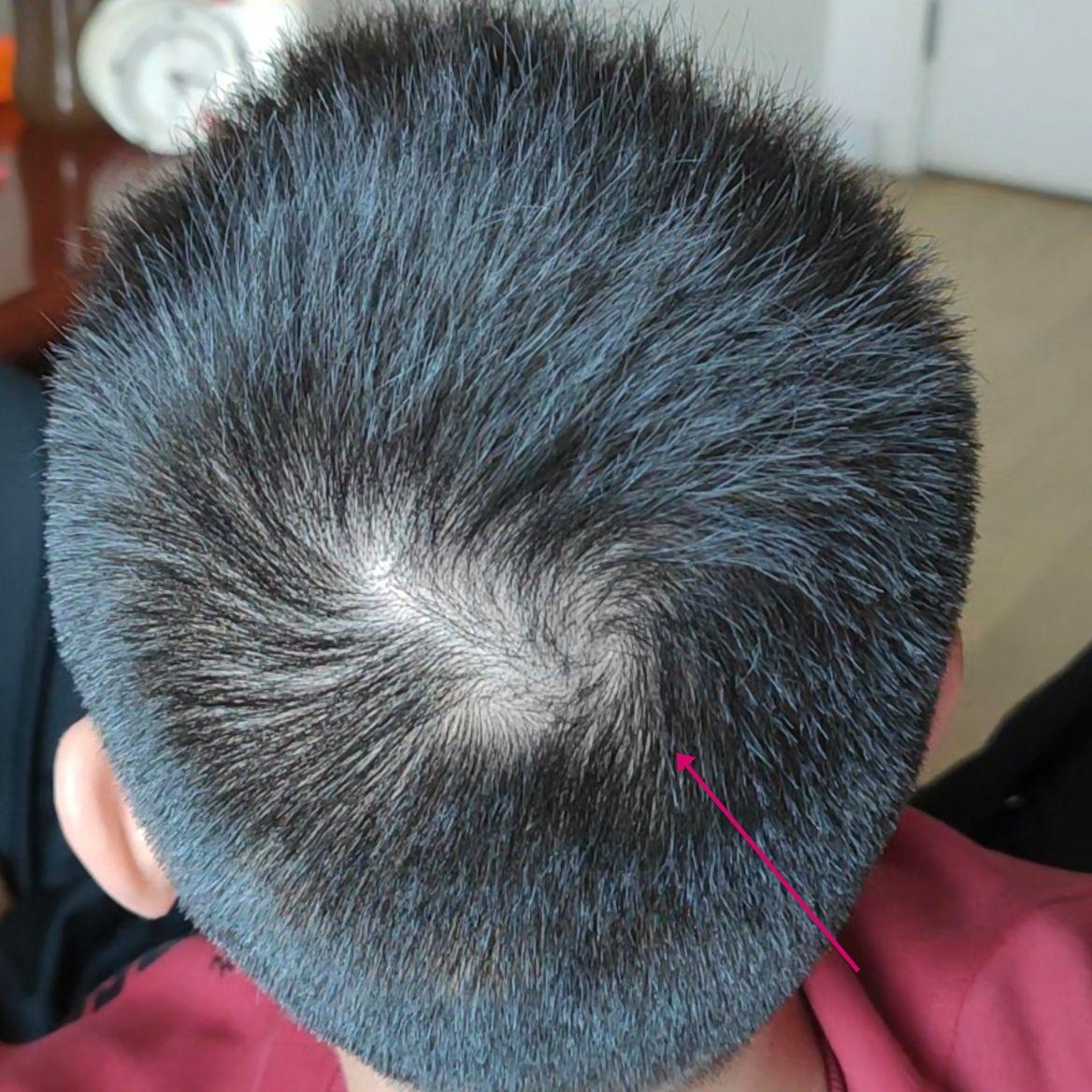 头上有四个旋是一种什么样的体验. - 知乎