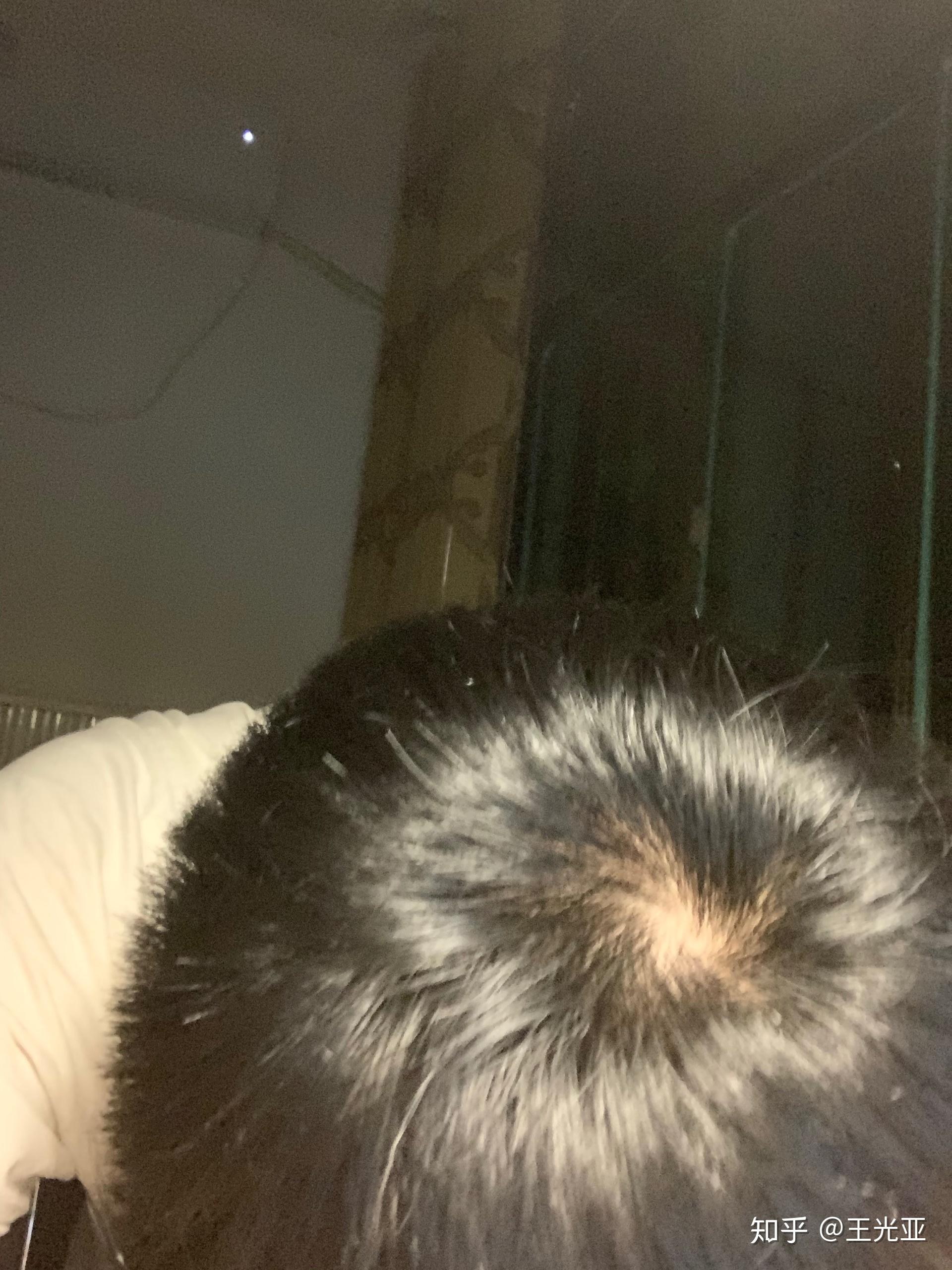 Bald in the middle head and begin no loss hair glabrous of mature Asian ...