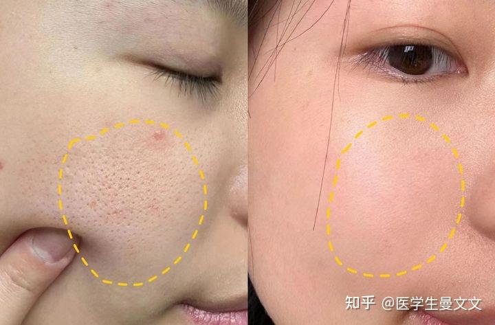 皮肤摸着像沙子一样特粗糙,毛孔密密麻麻,【皮肤科医生】教你1招收缩