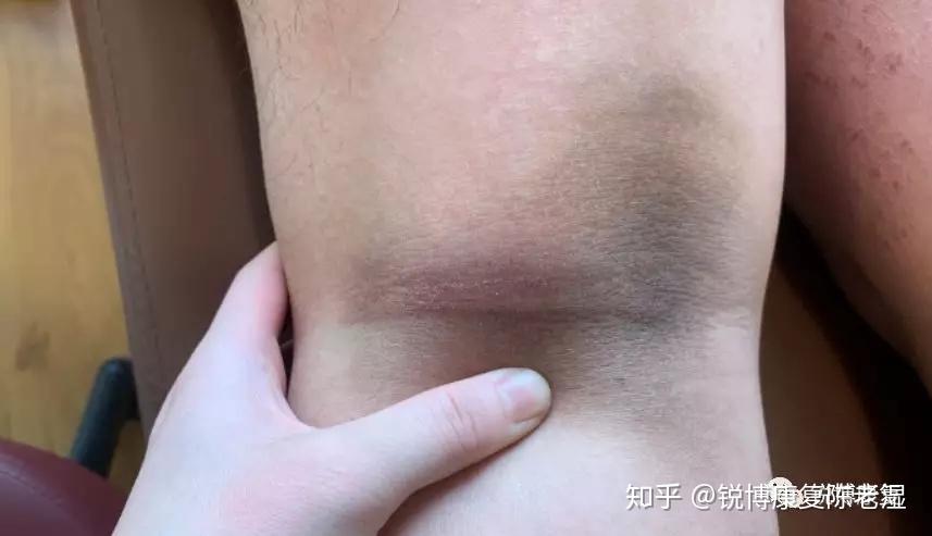 腘窝疼痛的常见原因有哪些