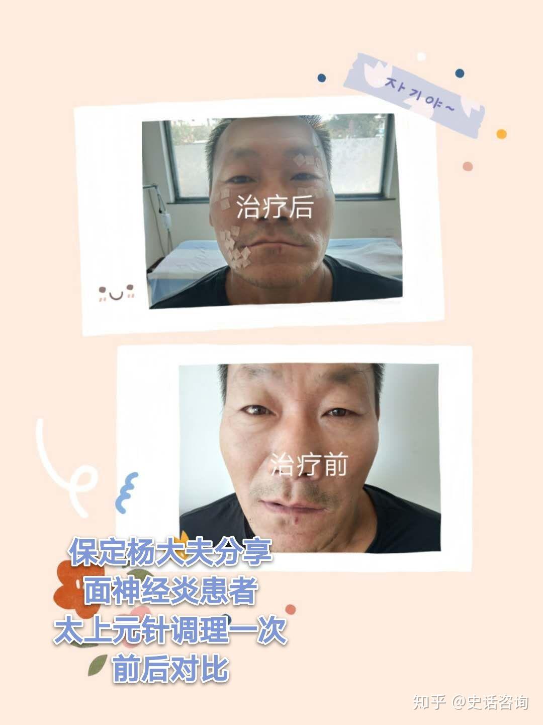 史明明治疗面瘫太上元针或许是最快的方法