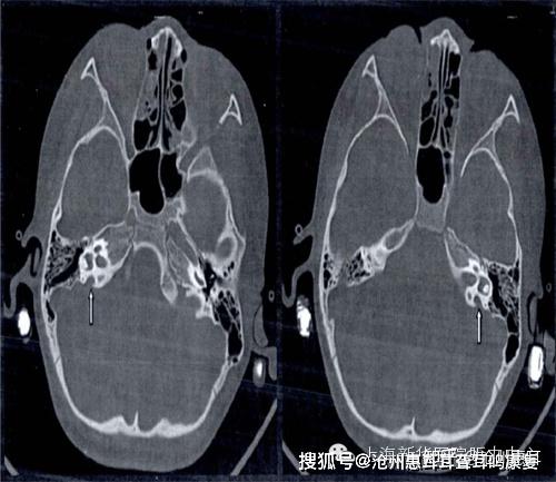 前庭水管解剖 – 側頭骨ct 解剖図 – NSTIXA