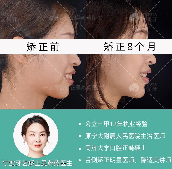 宁波舌侧正畸|嘴突+露龈笑,矫治9个月完成! - 知乎