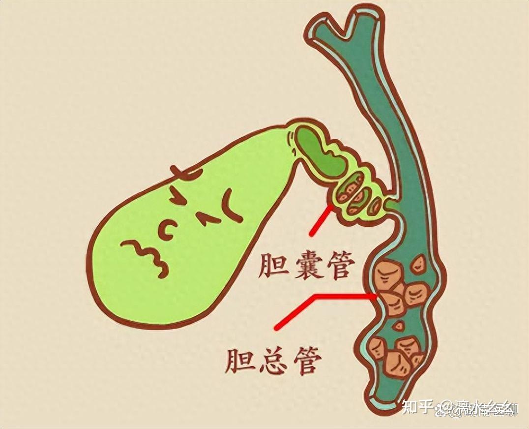 肝内胆管结石真的不用管吗
