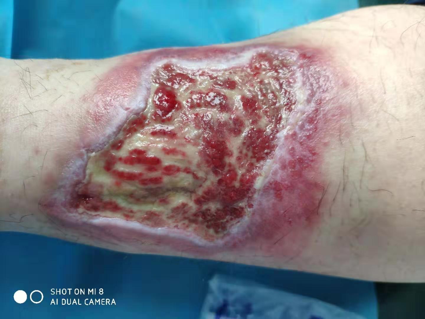 烧伤或者夹伤坏死的皮肤不一定非要植皮 知乎 烧伤或者夹伤坏死的皮肤不一定非要植皮 知乎