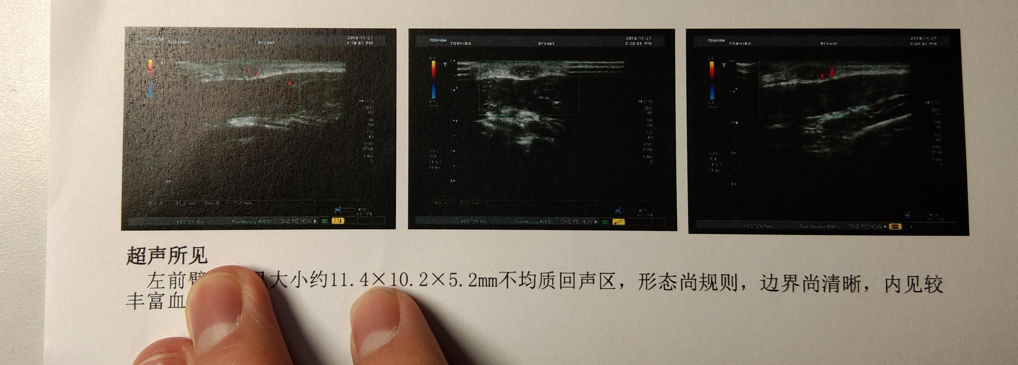 脂肪瘤到底做手术好还是留着无所谓