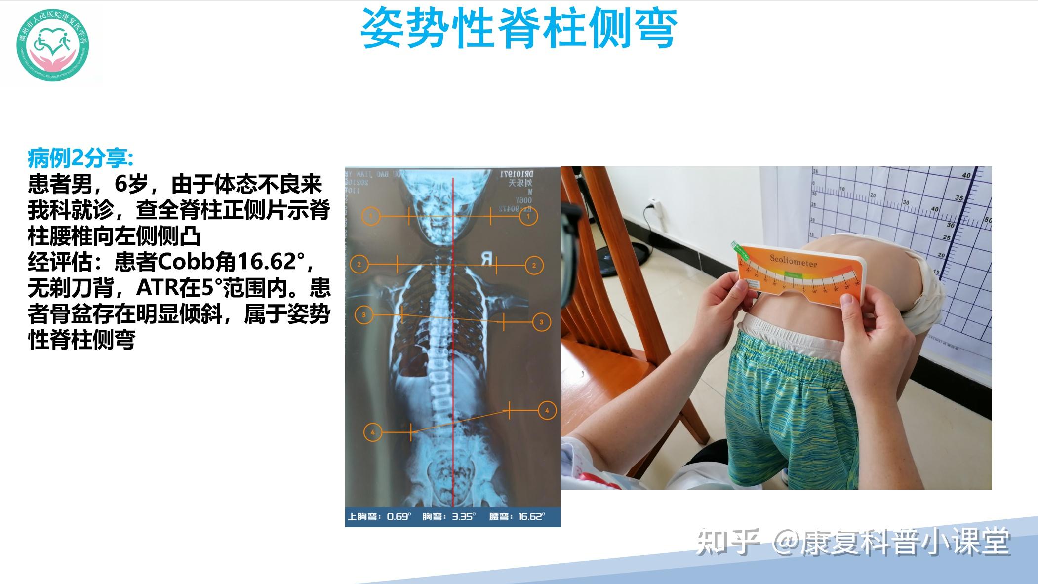 特发性脊柱侧弯的诊疗策略 - 知乎