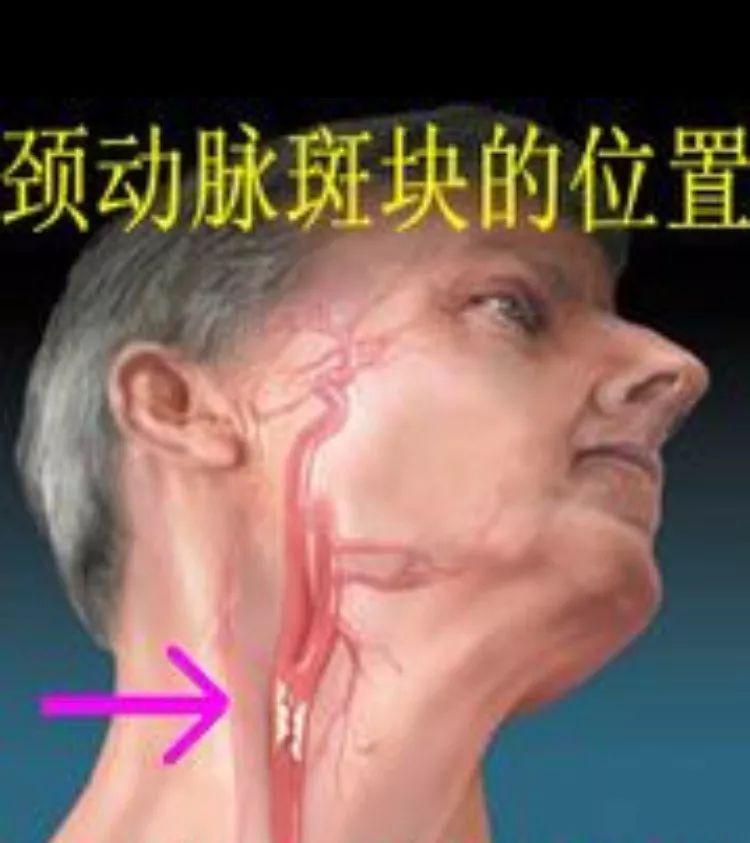 ▼▼▼的位置在哪里?颈动脉窦▼什么是颈动脉窦?