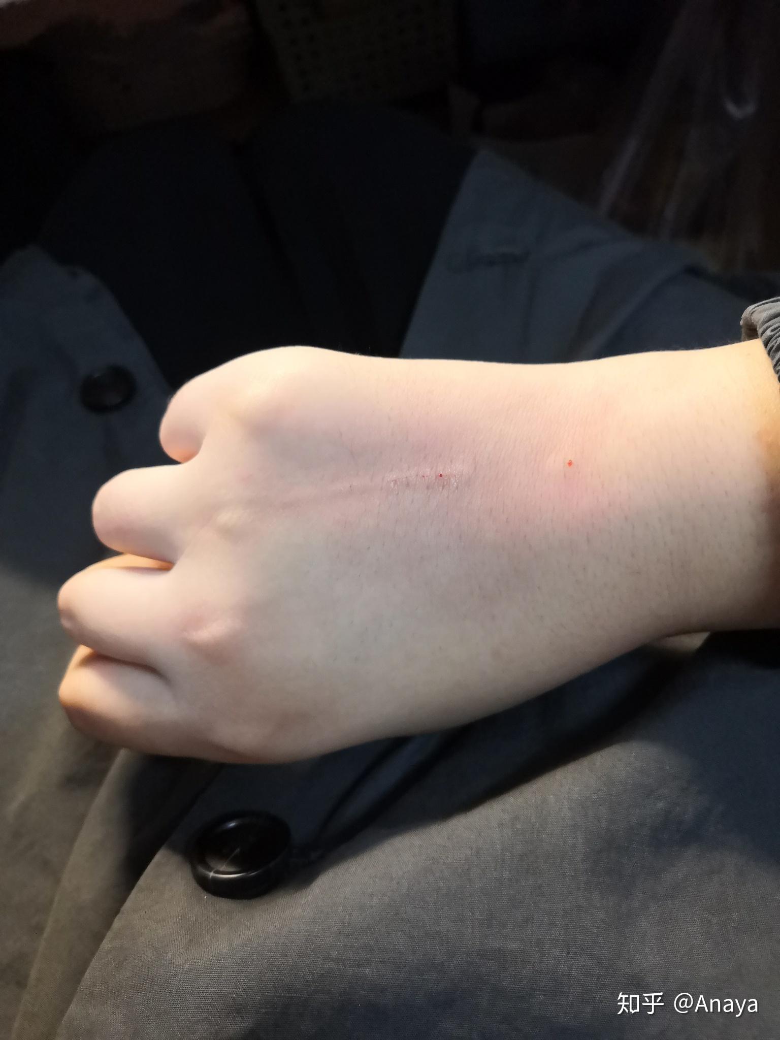 被猫抓破皮出血 要打针么? - 知乎