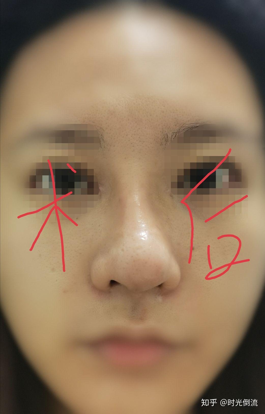 膨体半肋骨鼻综合全取出鼻头会挛缩么? - 知乎
