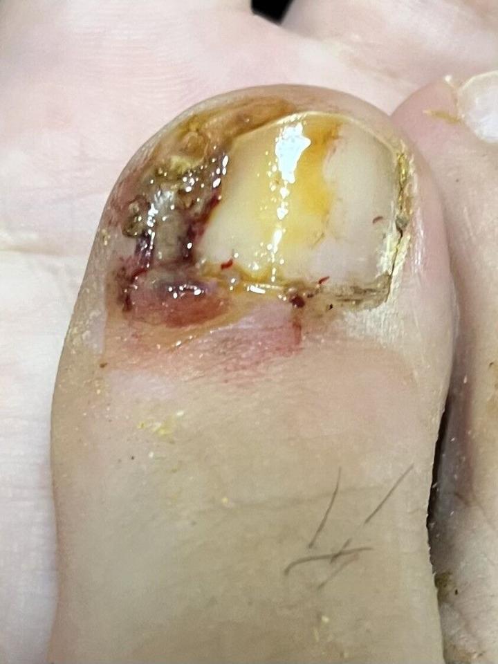 如果甲沟炎已经开始化脓了,自己应该怎么处理