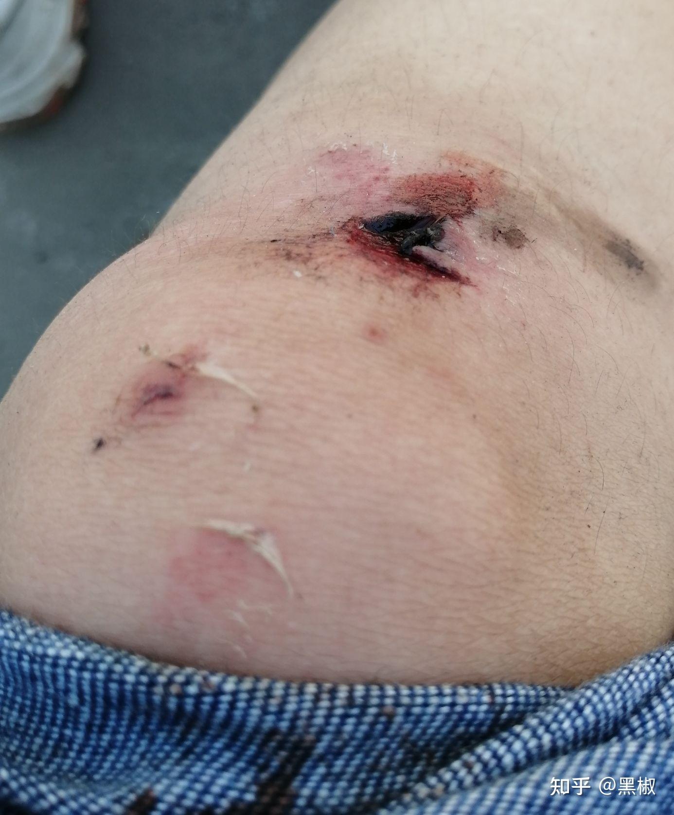 骑电动车摔伤腿图片图片