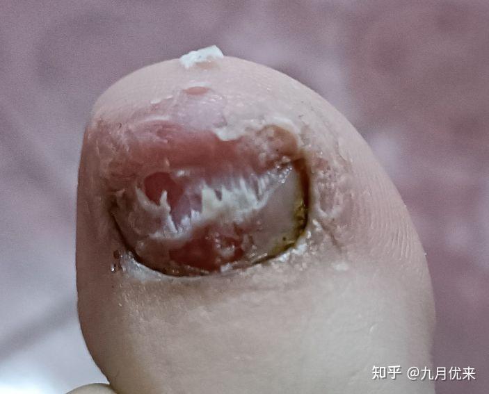 教你正确使用冰酸醋,我根治了6年的灰指甲,手足癣,脚气一起根治,真实