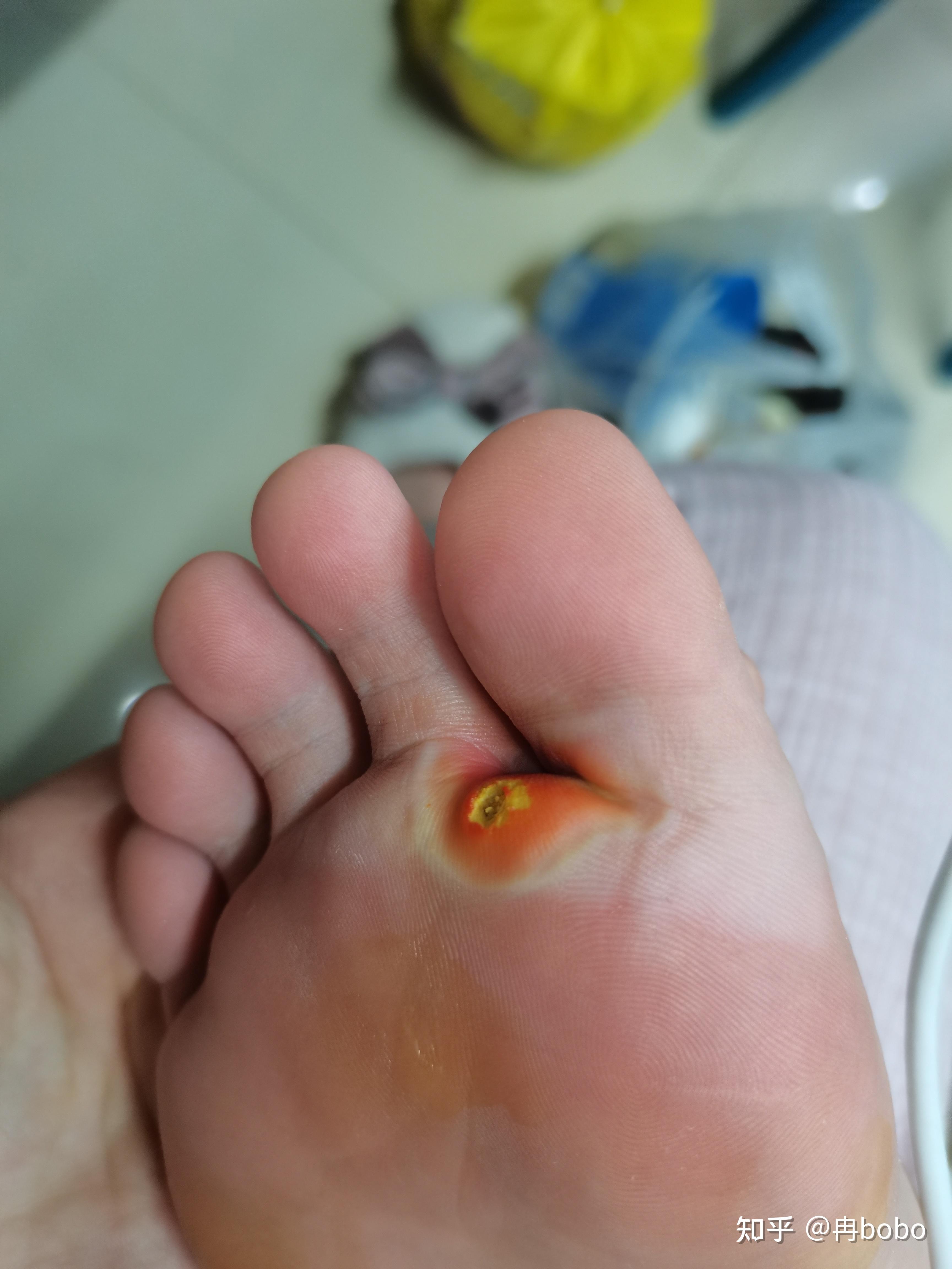 室友挖鸡眼是一种怎样的体验? - 知乎