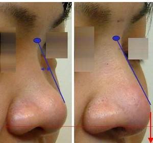 成功的垫鼻梁案例图,没有假体感