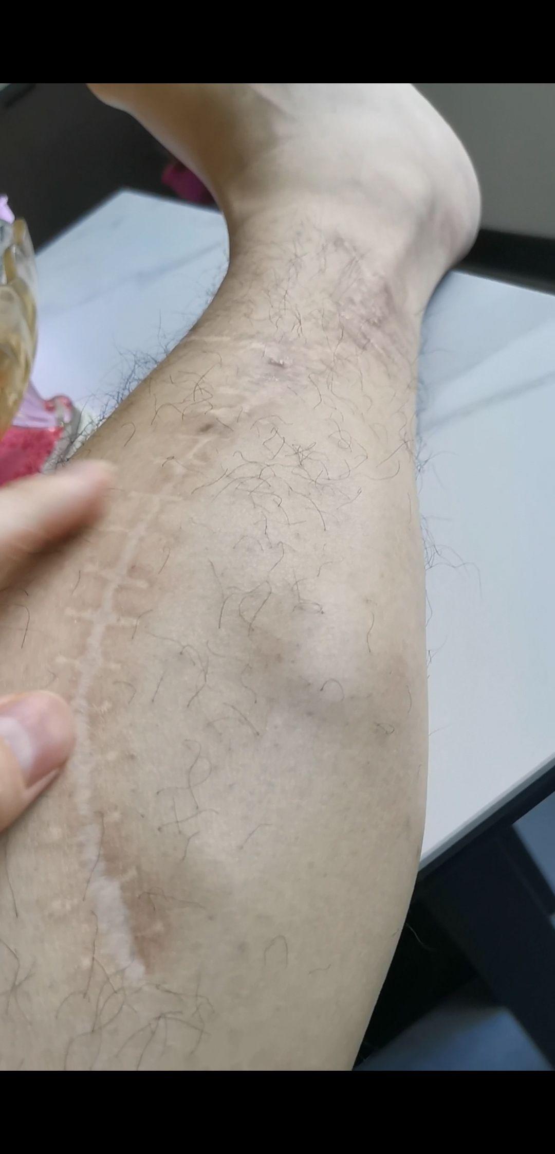 有没有人有小腿肌疝?怎么感觉这个病没法子治?