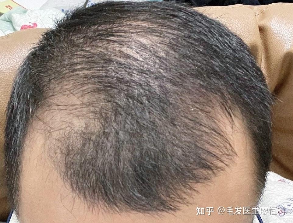 毛发科普|雄秃的原因?如何判断雄秃?雄秃怎么办? - 知乎