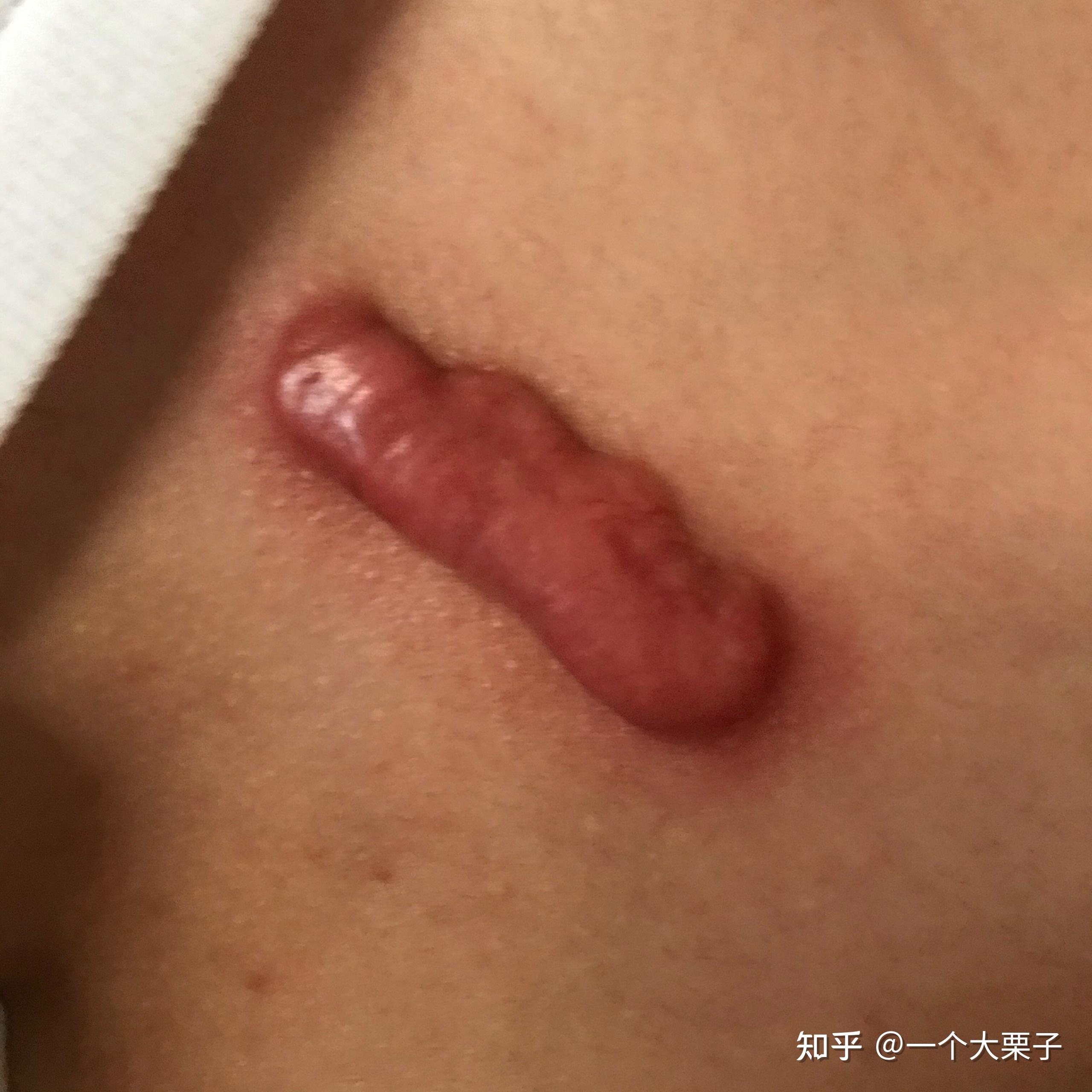 大腿根部红色疤痕图片