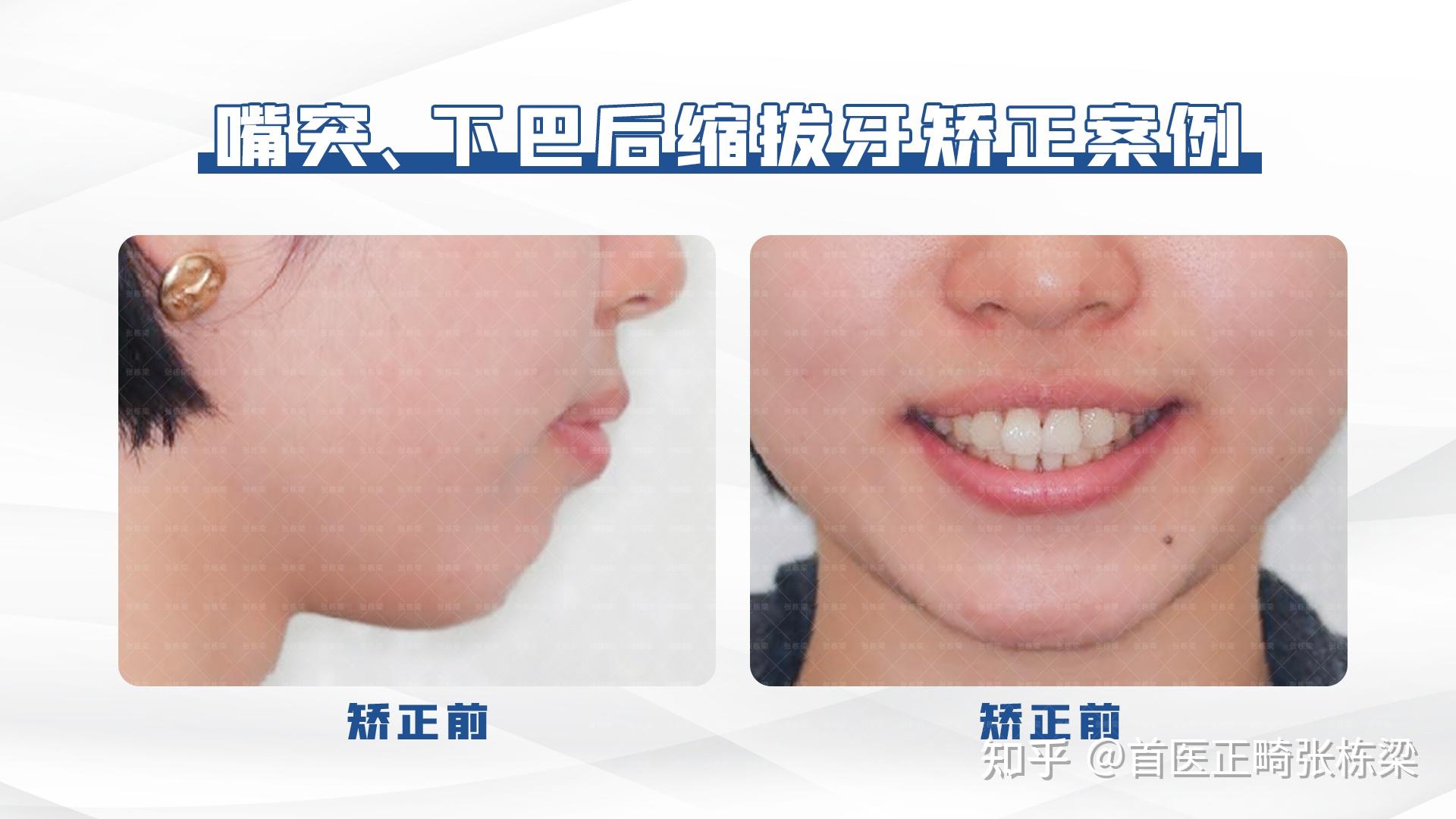 北京牙齿矫正 | 高难度骨性前突没下巴，舌侧牙齿矫正重获自信！ - 知乎