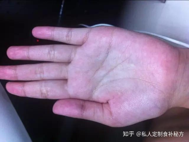 4,紫色手掌部呈暗红或间有紫色斑点,常见于肝脏疾病,如慢性肝炎,肝