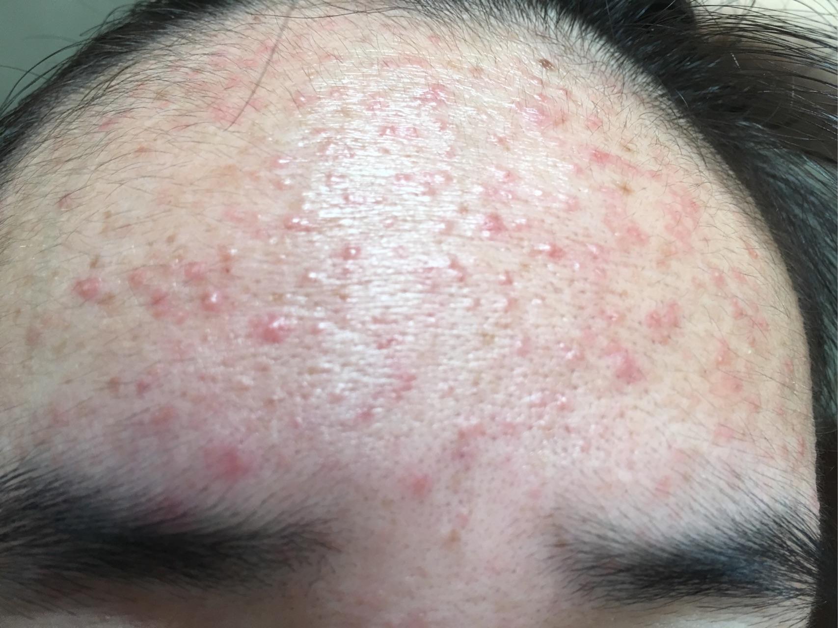 求救额头上长满了密密麻麻的痘痘很小颗