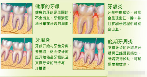 牙周炎自愈最佳方法图片