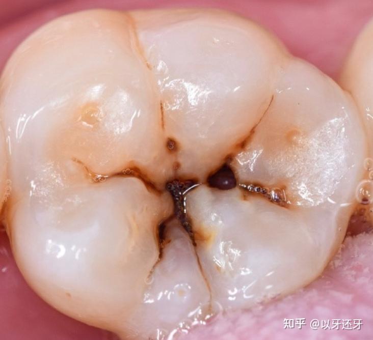 牙齿咬合不正可能引起很多问题?