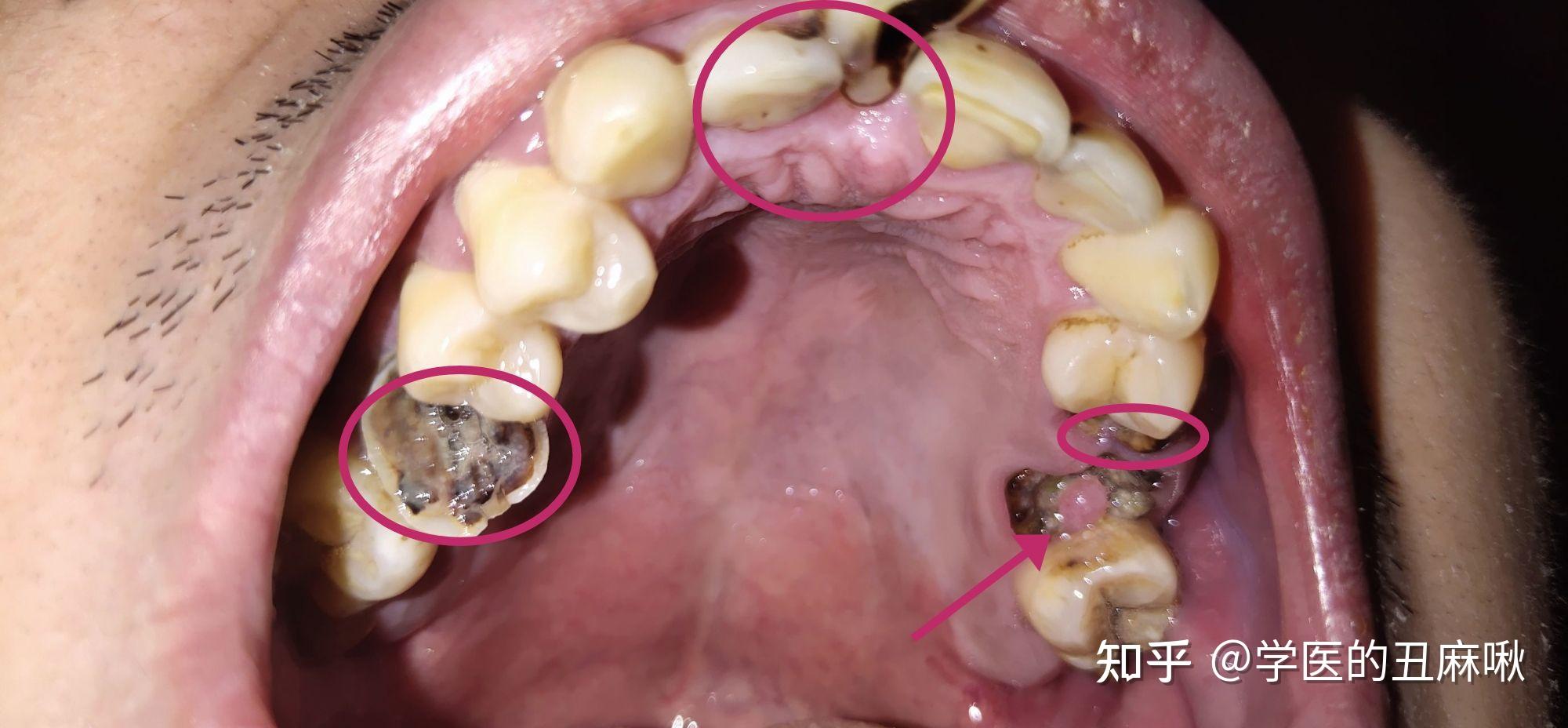 龋齿这个程度怎么办?