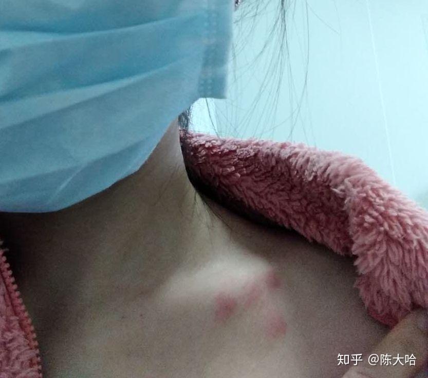 被跳蚤咬的全身都是包是什么样的感受