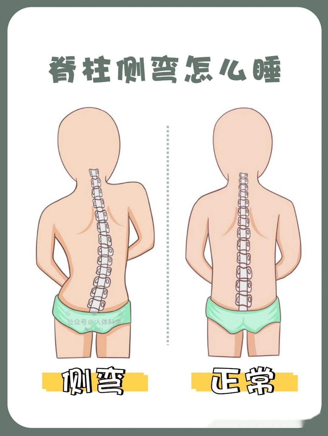 脊柱侧弯身体侧弯的常见错误体态和改善动作