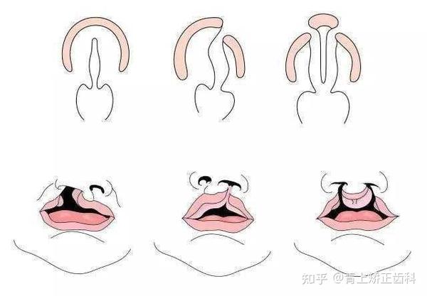 儿童兔唇是什么原因形成的?青上来带你揭秘! - 知乎