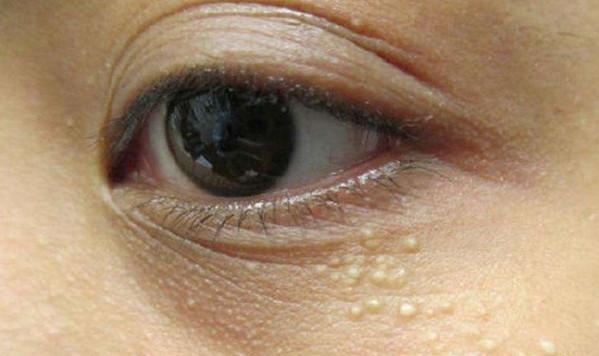 脂肪粒大作战 重回颜值巅峰 知乎