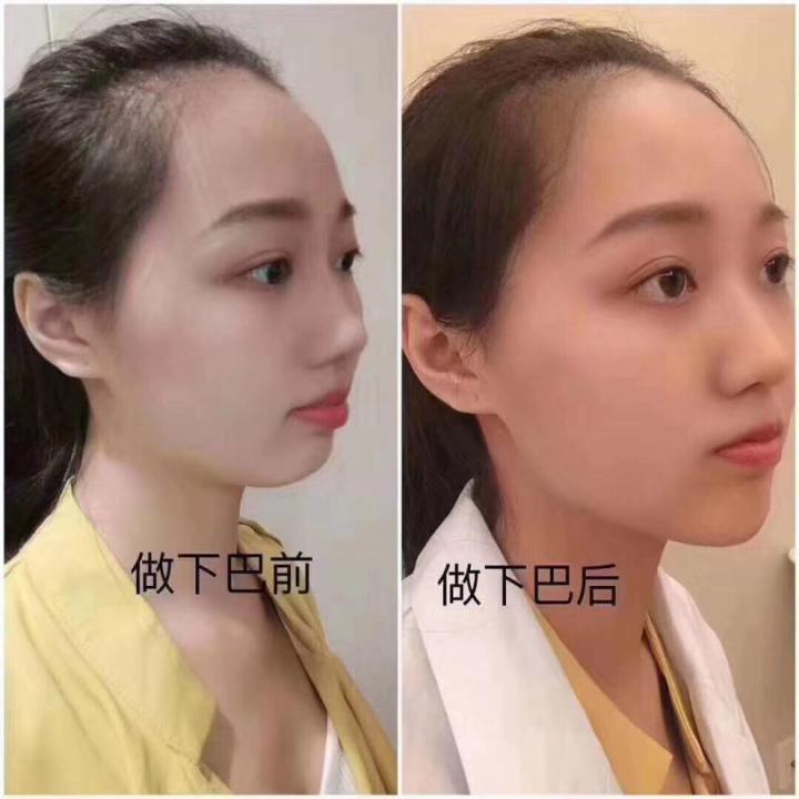下巴后缩怎么改善？做玻尿酸还是假体效果会更 …