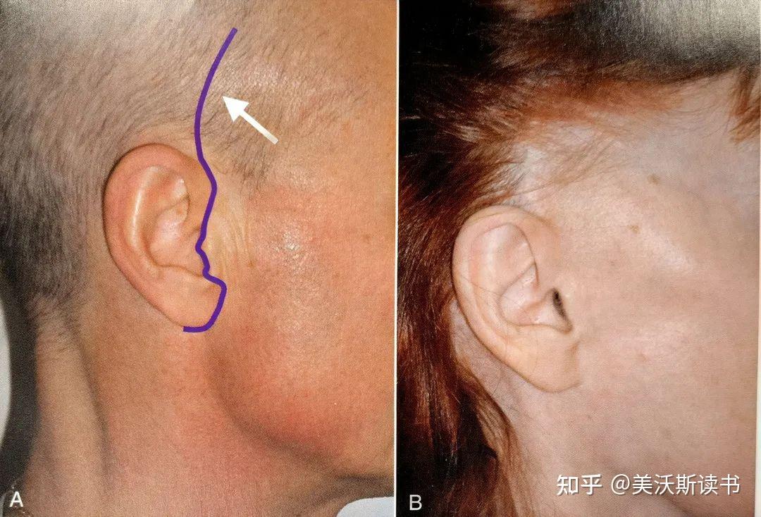 外科医生的签名:手术切口设计 - 知乎