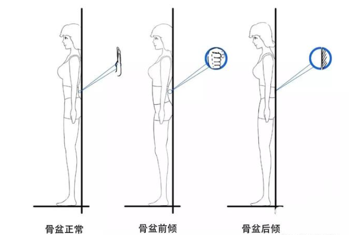 怎么测骨盆正不正 v2-29aa0e26d09c10ea6754dbf2bcc02cf1_1440w.jpg